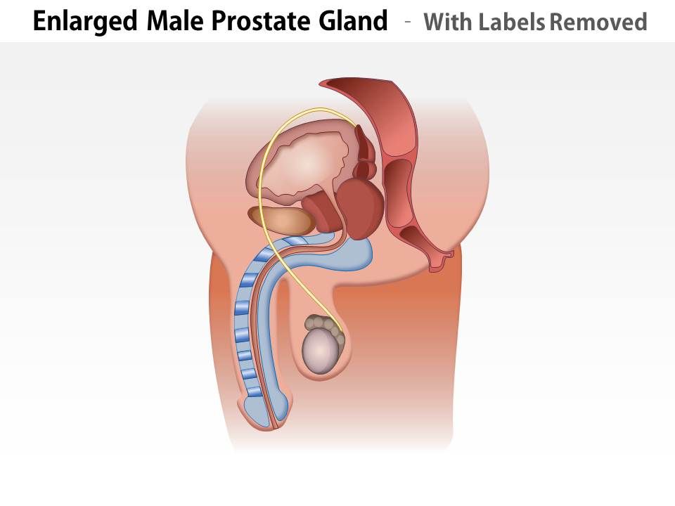 0814 Illustration Of An Enlarged Male Prostate Gland ...