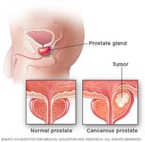 10 Interesting Prostate Cancer Facts