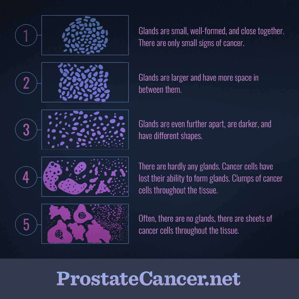 [1/3] AI based Gleason Grading for Prostate Cancer