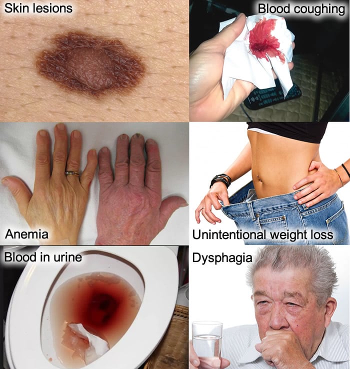 14 Typical Signs and Symptoms of Cancer