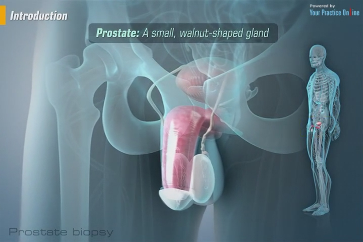 How long do you have incontinence after prostate surgery