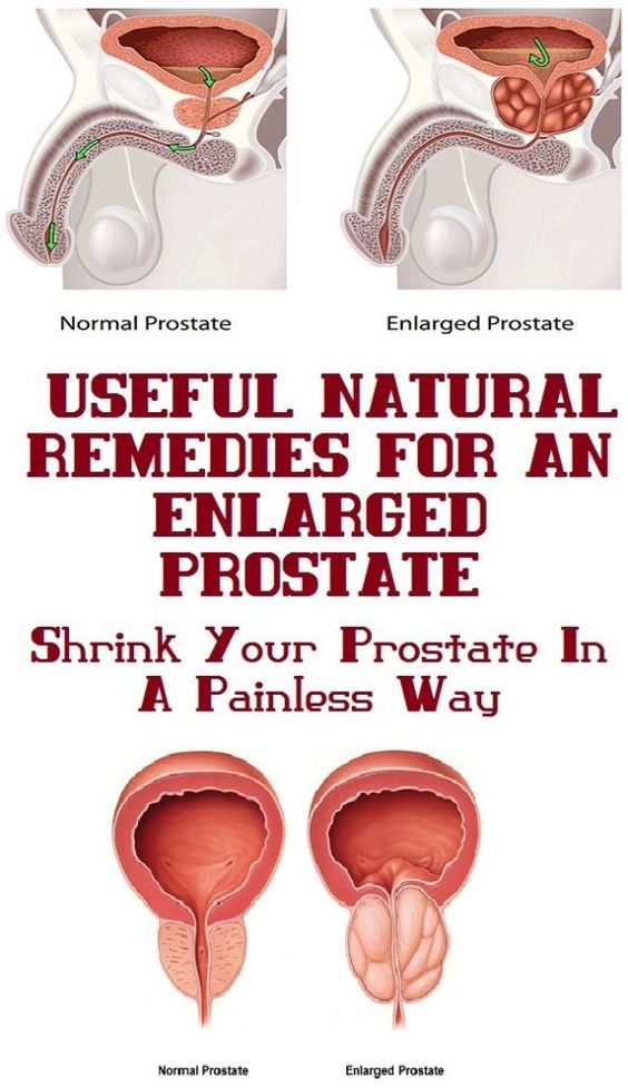 4 Natural Home Remedies For benign prostatic hyperplasia ...