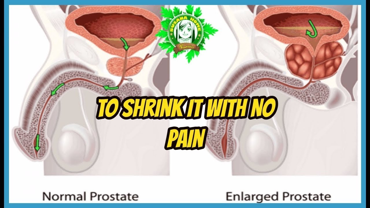 9 Natural Cures For Enlarged Prostate To Shrink It With No ...