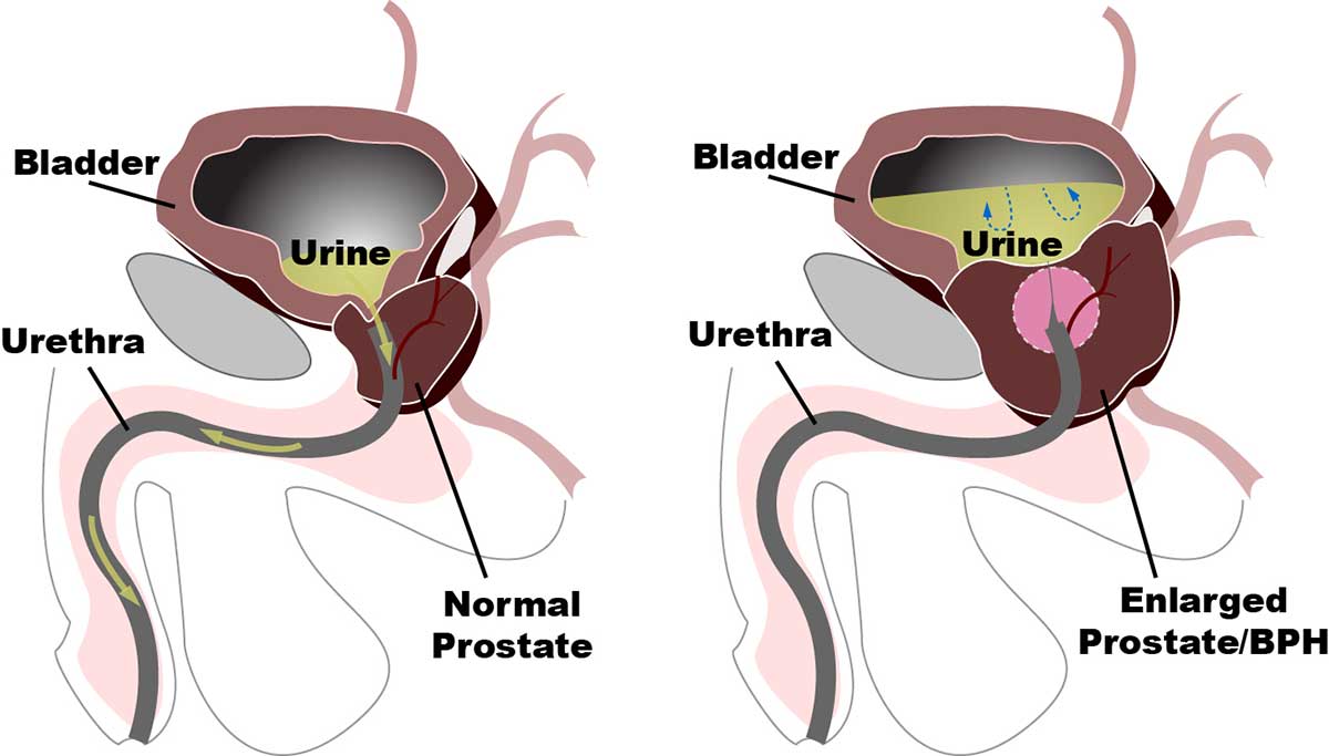 9 Useful Natural Remedies for Enlarged Prostate  Shrink ...