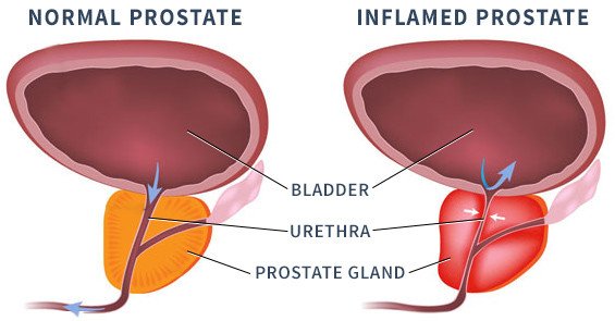 A Better Path to Diagnosing Prostatitis
