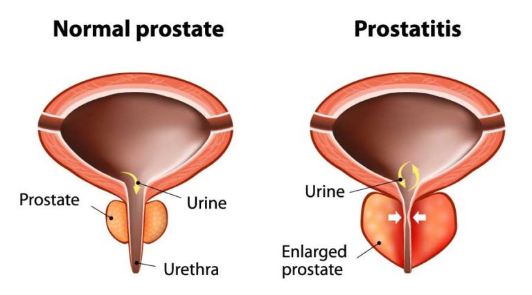 A Look at the 3 Most Common Prostate Problems