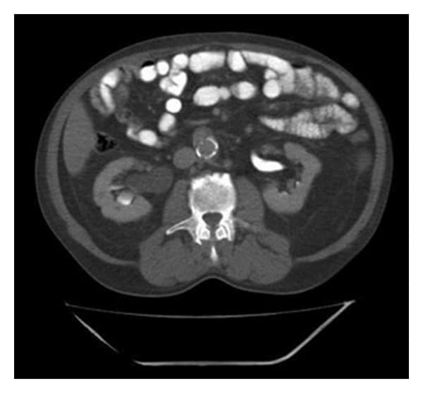 A Rare Location of Metastasis from Prostate Cancer: Hydronephrosis ...