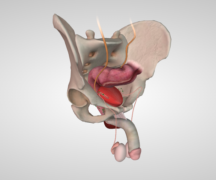 About Your Prostate Ablation Procedure