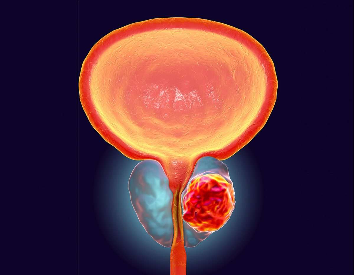Aggressive Prostate Cancer Metastasis Mechanisms Uncovered