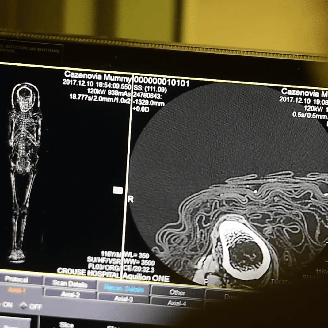 Ancient Mummy Diagnosed With Rare Cancer After CT Scan Study