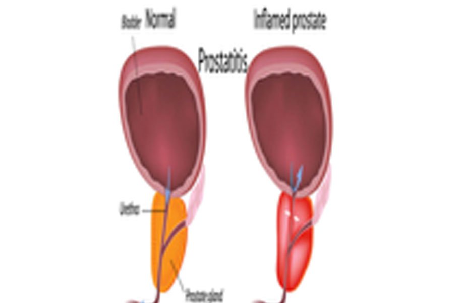 Asymptomatic Inflammatory Prostatitis (Prostatitis)