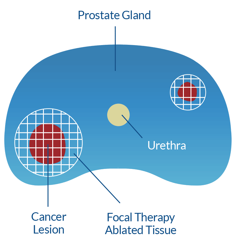 Avoid side effects of prostate cancer