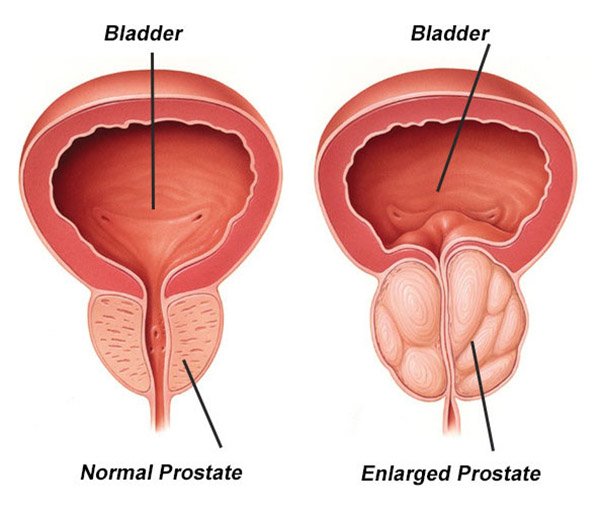 Benign Prostatic Hyperplasia (BPH): Symptoms &  Treatments