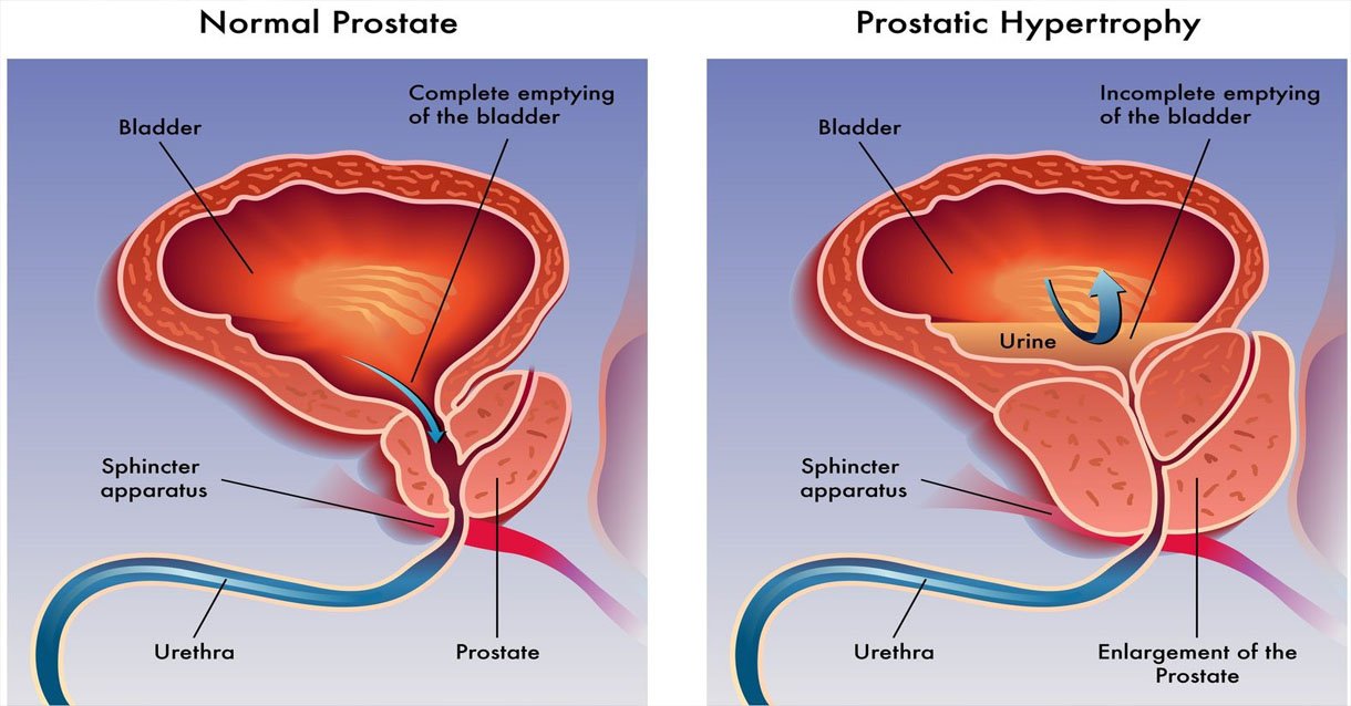 Benign Prostatic Hyperplasia (BPH) Treatment in Kuala ...