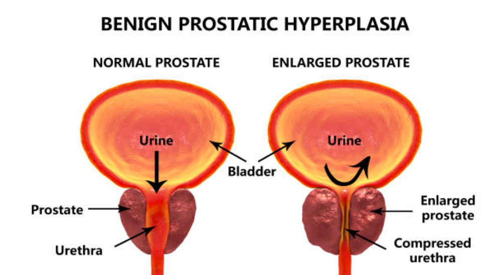 Benign Prostatic Hyperplasia: Causes, Risk Factors and ...