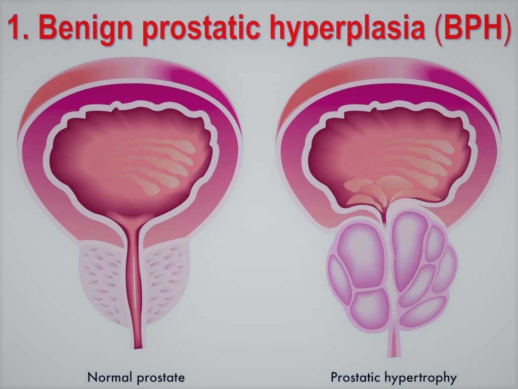 Benign Prostatic Hyperplasia Treatment