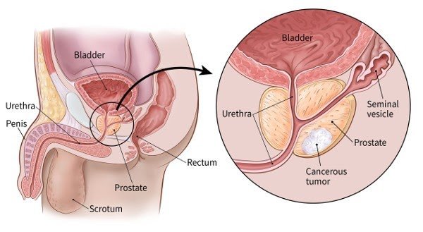 Blood In Stool Prostate