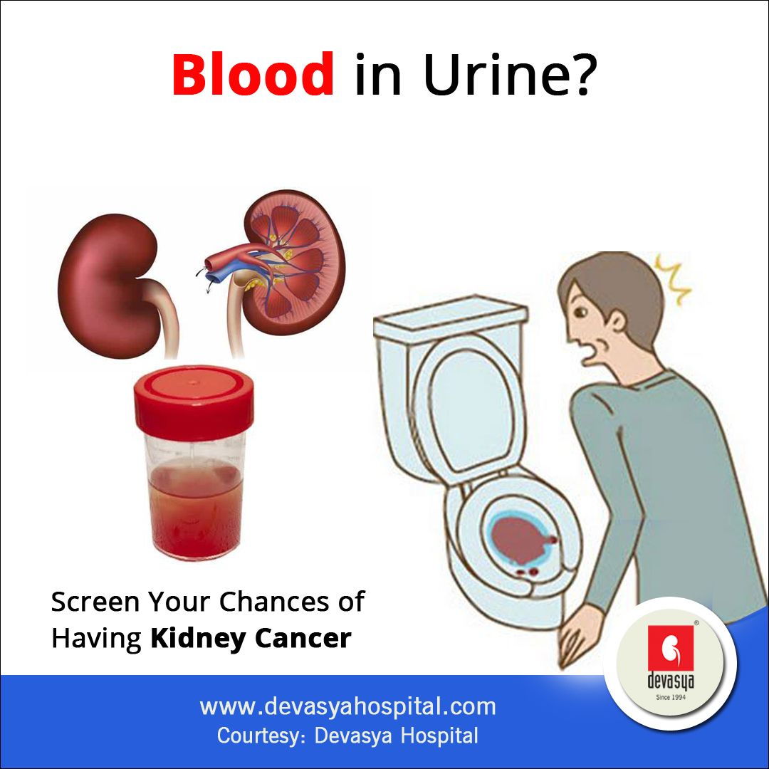 Blood In Urine Kidney Cancer Symptoms