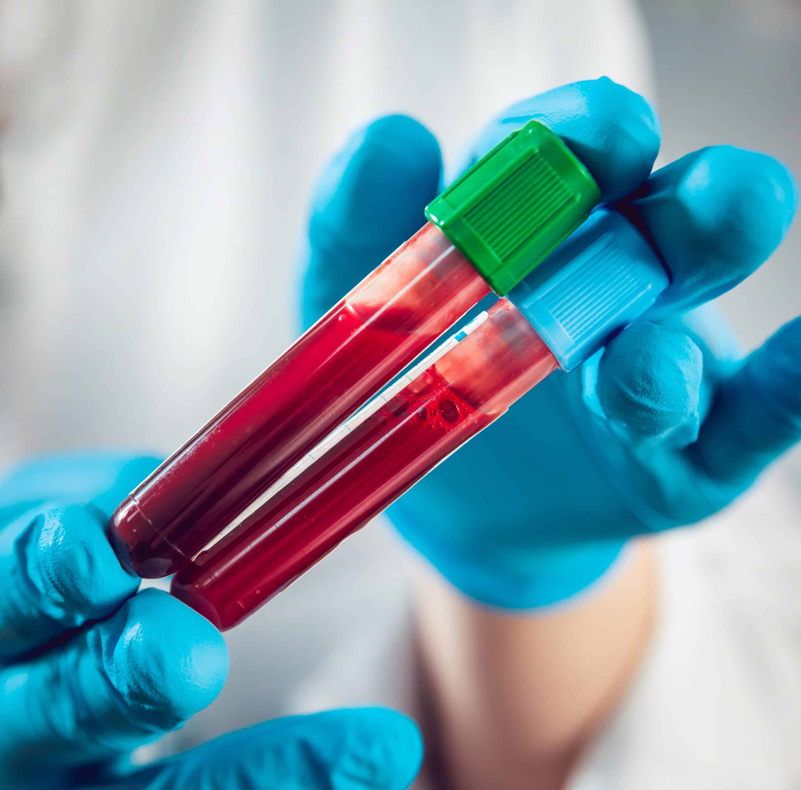 Blood test superior to PSA for detecting high