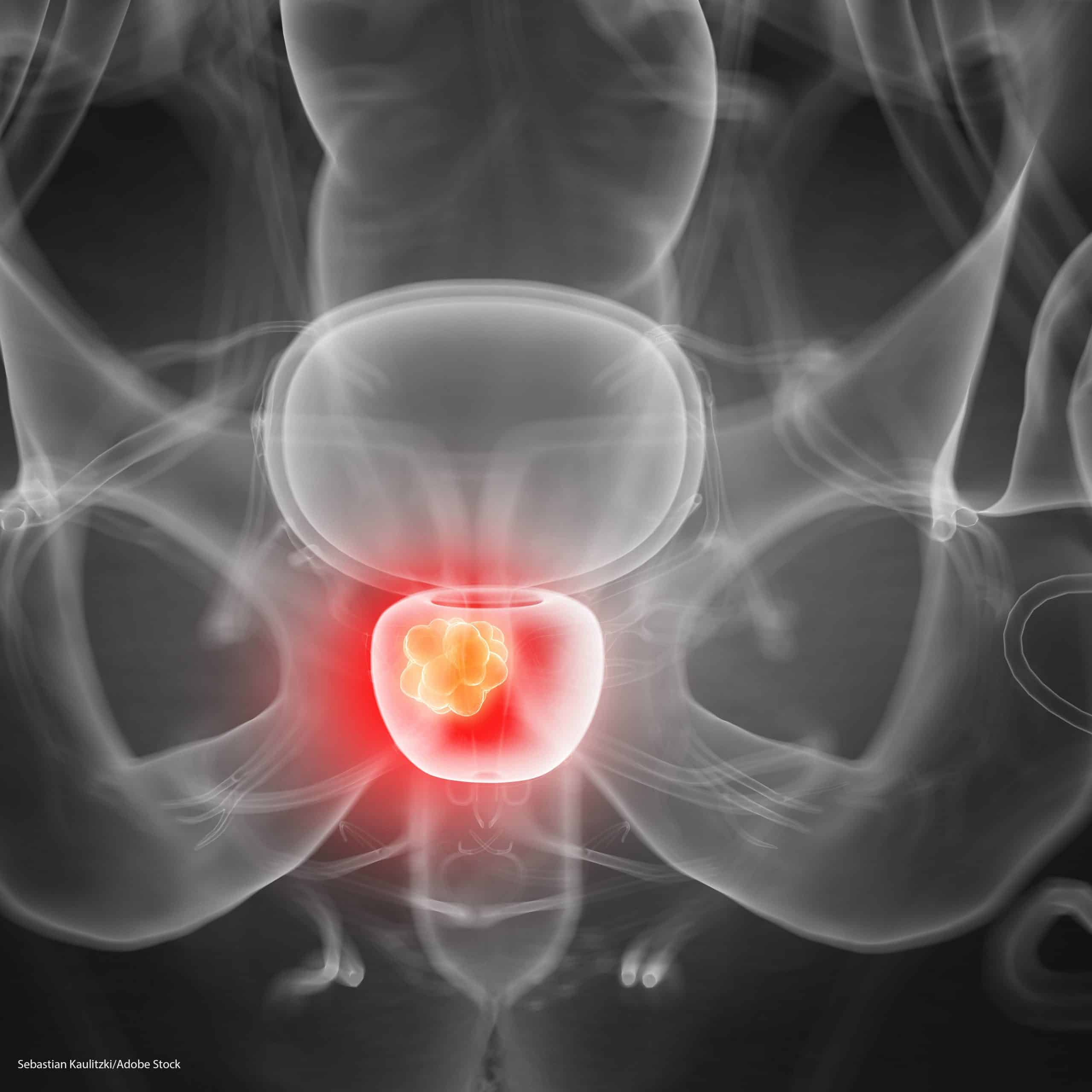 Bowel Problems After Radiotherapy For Prostate Cancer ...
