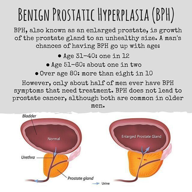 BPH Visit us on enlargedprostatesolution.com Via prostate issues # ...