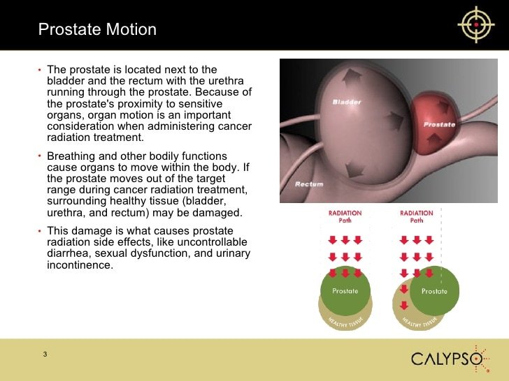 Calypso Prostate Radiation Treatment