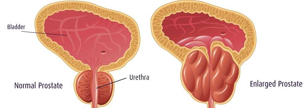 Can an enlarged prostate cause a urinary tract infection (UTI) in men?