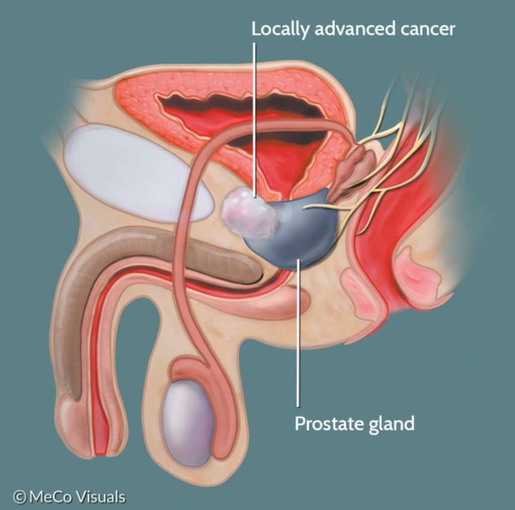 Can Your Prostate Grow Back After Surgery