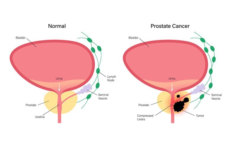 Circulating tumour DNA as a prognostic tool in prostate cancer