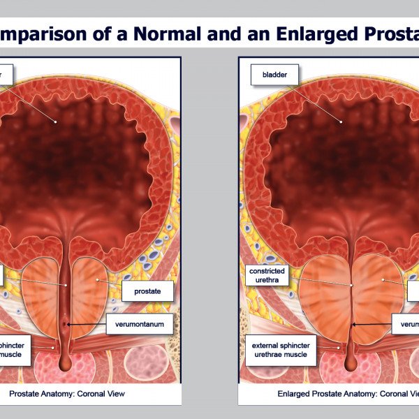 Comparison of a Normal and an Enlarged Prostate ...