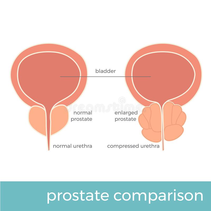 Comparison Of Healthy And Cancer Prostate Illustration Stock Vector ...
