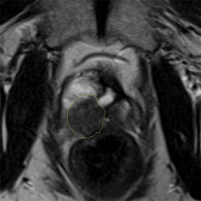 Compressed Sensing Radial Sampling MRI of Prostate Perfusion: Utility ...