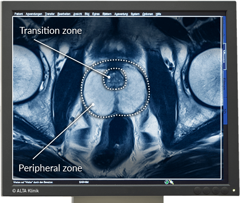 Ct Scan Prostate Enlargement