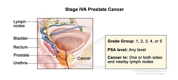 Definition of stage IV prostate cancer