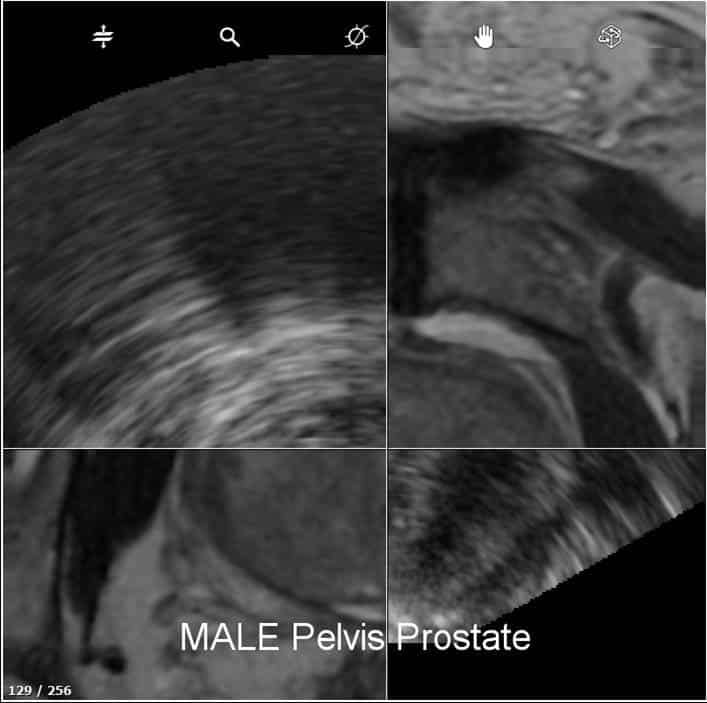 Detection rate of MRI fusion ultrasound prostate biopsy with ...