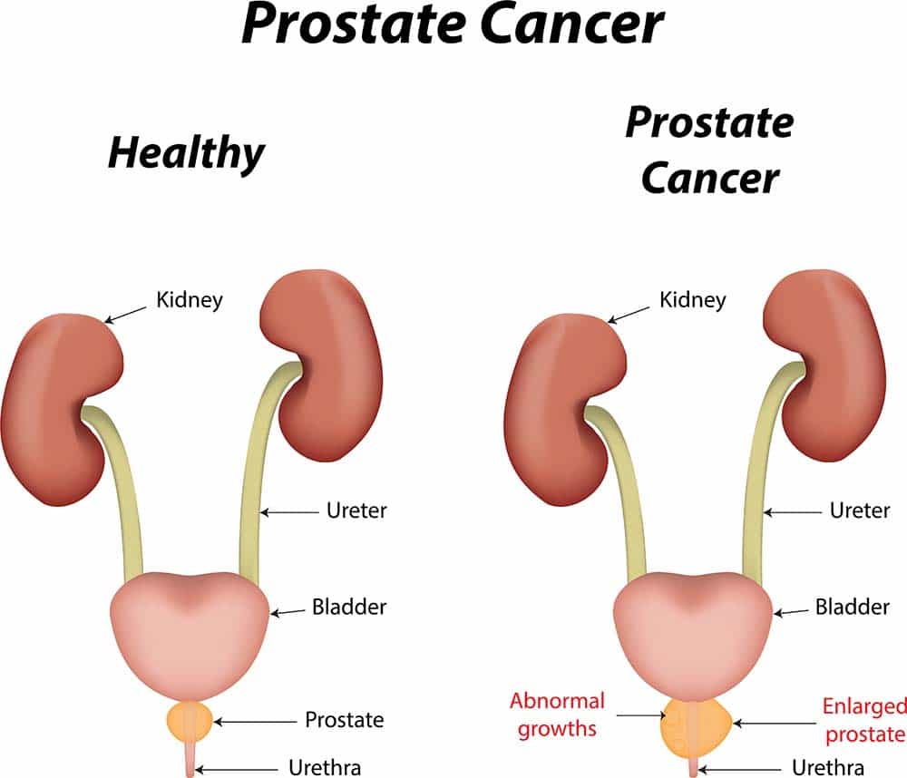 Different Types of Treatment For Prostate Cancer