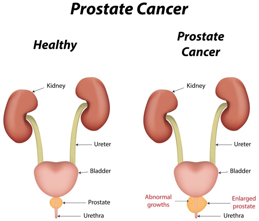 Do Women Get Prostate Cancer