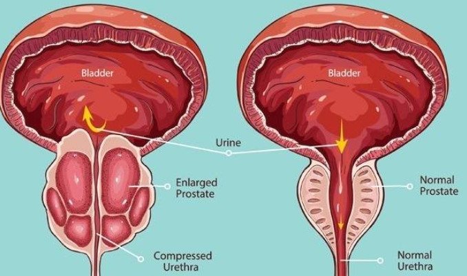 Do you know what prostate cancer is and how it is treated ...