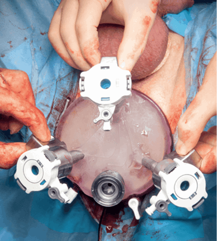 Drains After Prostate Surgery