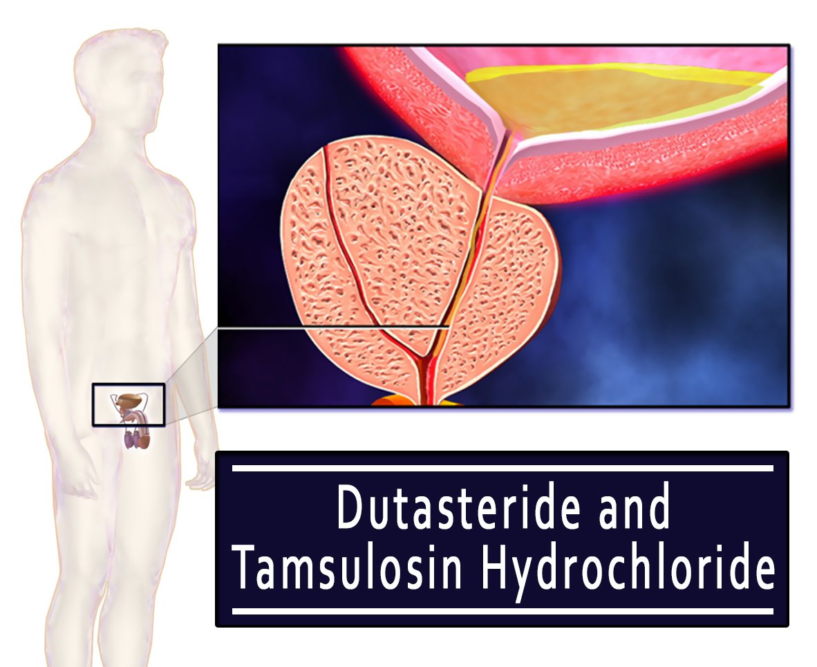 Dutasteride and Tamsulosin Hydrochloride