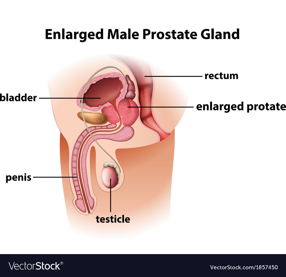 Enlarged male prostate gland Royalty Free Vector Image