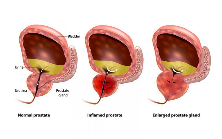Enlarged Prostate  Chennai