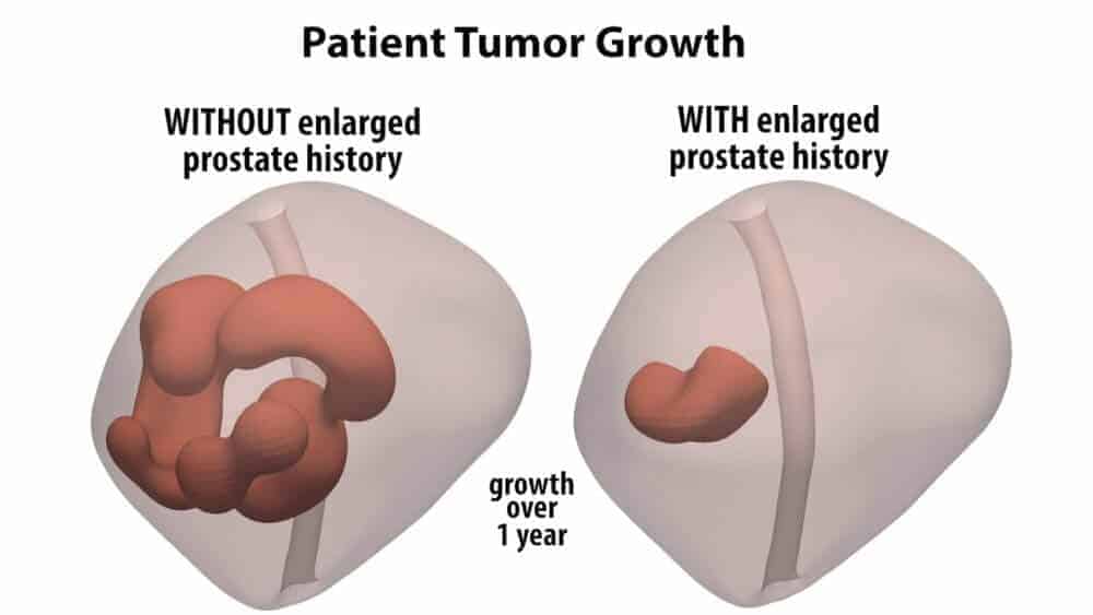 Enlarged prostate could actually be stopping tumor growth ...