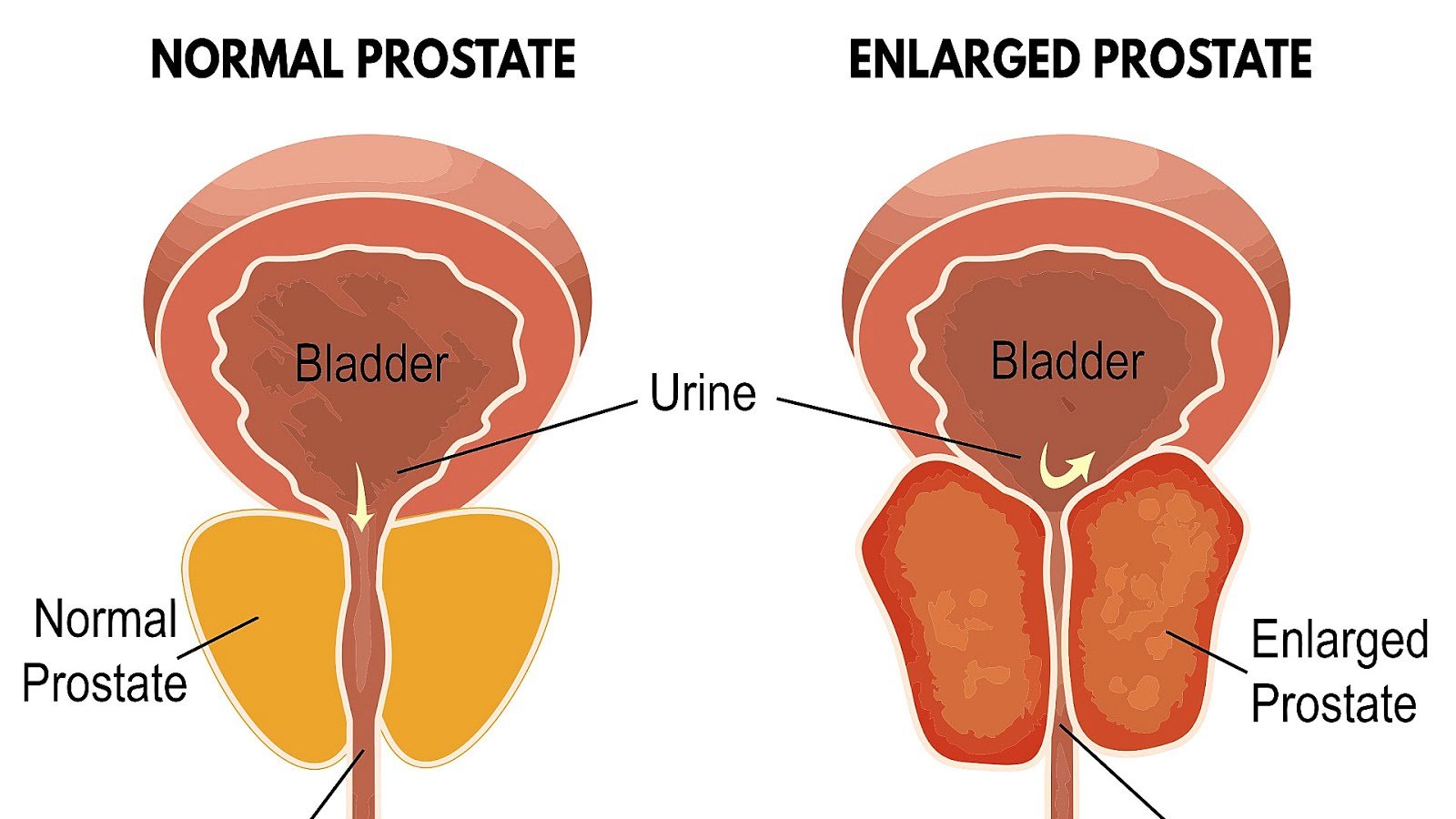 Enlarged Prostate Surgery Side Effects