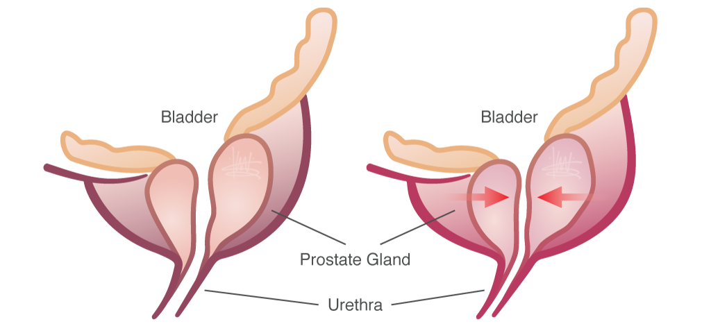 Enlarged Prostate Symptoms and Treatments  ClinicalPosters