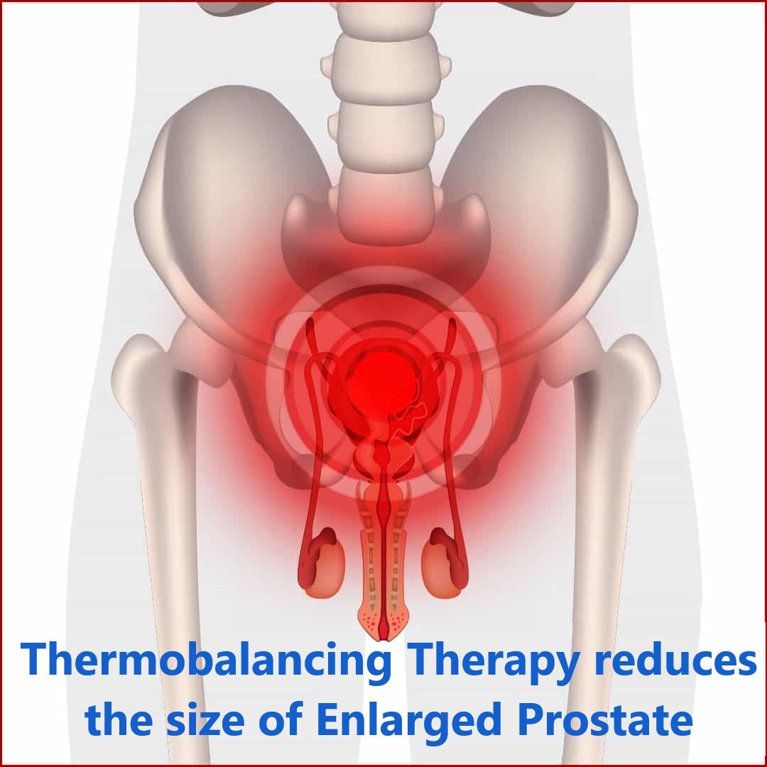 Enlarged Prostate Thermobalancing Treatment Can now Help ...