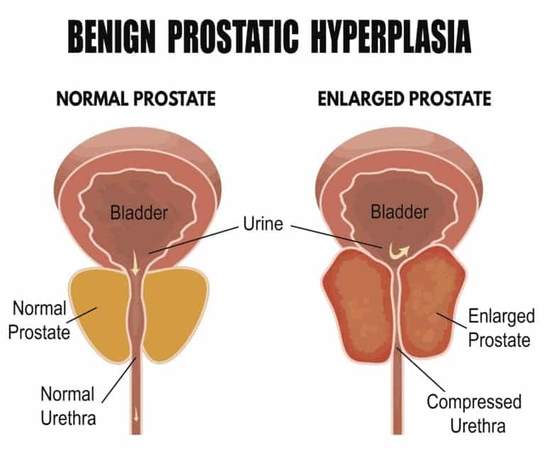 Enlarged Prostate Treatment (Laser Ablation Surgery)