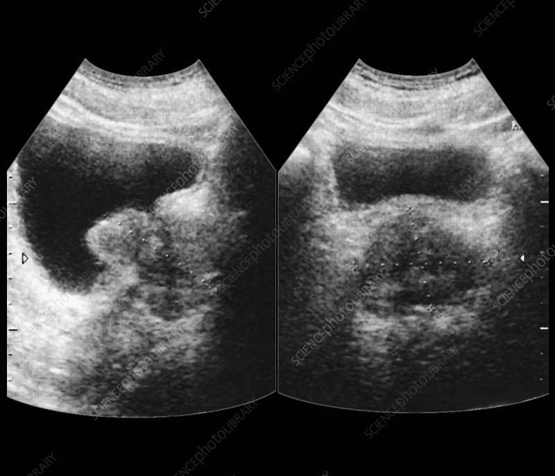 Enlarged prostate, ultrasound scan