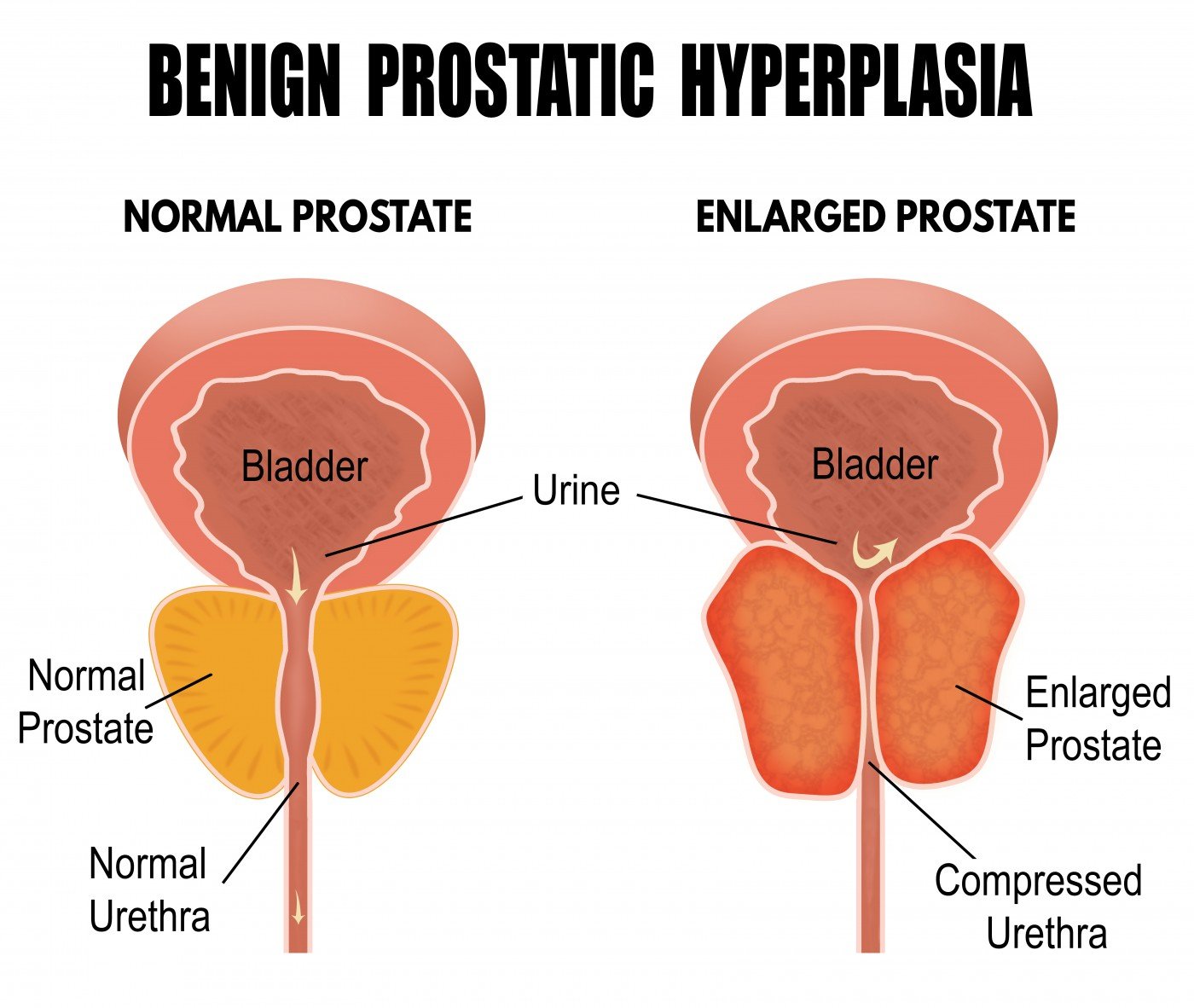 Enlarged Prostate: What You Need to Know