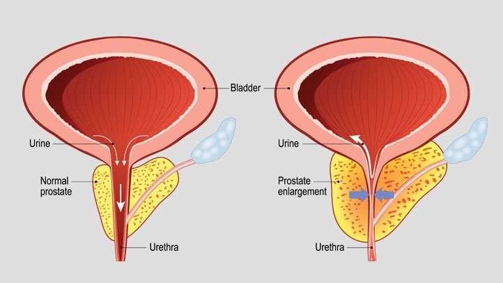 Enlarged (Swollen) Prostate: How to Treat It with Cialis ...